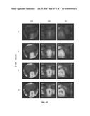 REAL-TIME IMAGING SYSTEM FOR MONITORING AND CONTROL OF THERMAL THERAPY     TREATMENTS diagram and image