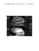 METHOD FOR EVALUATING BLUSH IN MYOCARDIAL TISSUE diagram and image