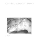 METHOD FOR EVALUATING BLUSH IN MYOCARDIAL TISSUE diagram and image