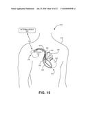 IDENTIFYING AMBIGUOUS CARDIAC SIGNALS FOR ELECTROPHYSIOLOGIC MAPPING diagram and image