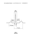 TWO ELECTRODE APPARATUS AND METHODS FOR TWELVE LEAD ECG diagram and image