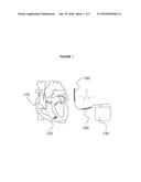 IMPLANTABLE CARDIAC SYSTEM HAVING AN R-SPIKE AMPLIFIER diagram and image
