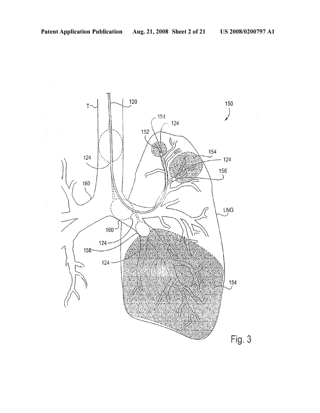 METHOD AND APPARATUS FOR ENDOBRONCHIAL DIAGNOSIS - diagram, schematic, and image 03