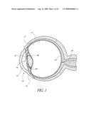 SYSTEM FOR TREATING OCULAR DISORDERS AND METHODS THEREOF diagram and image