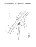 SYSTEM FOR TREATING OCULAR DISORDERS AND METHODS THEREOF diagram and image