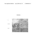 Method for the treatment of breast cancer diagram and image