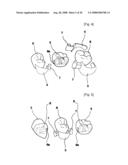 Dental Prosthesis and Its Manufacturing Method diagram and image