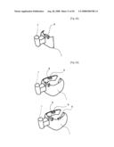 Dental Prosthesis and Its Manufacturing Method diagram and image