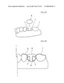 Dental Prosthesis and Its Manufacturing Method diagram and image