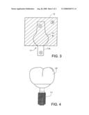 Integrated Dental Abutment Block diagram and image