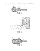 Method and apparatus for removal of cerumen diagram and image