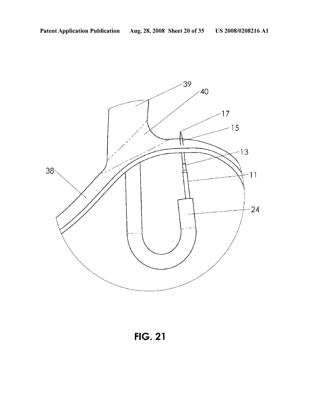 METHODS AND DEVICES FOR ENDOSCOPIC TREATMENT OF ORGANS - diagram, schematic, and image 21