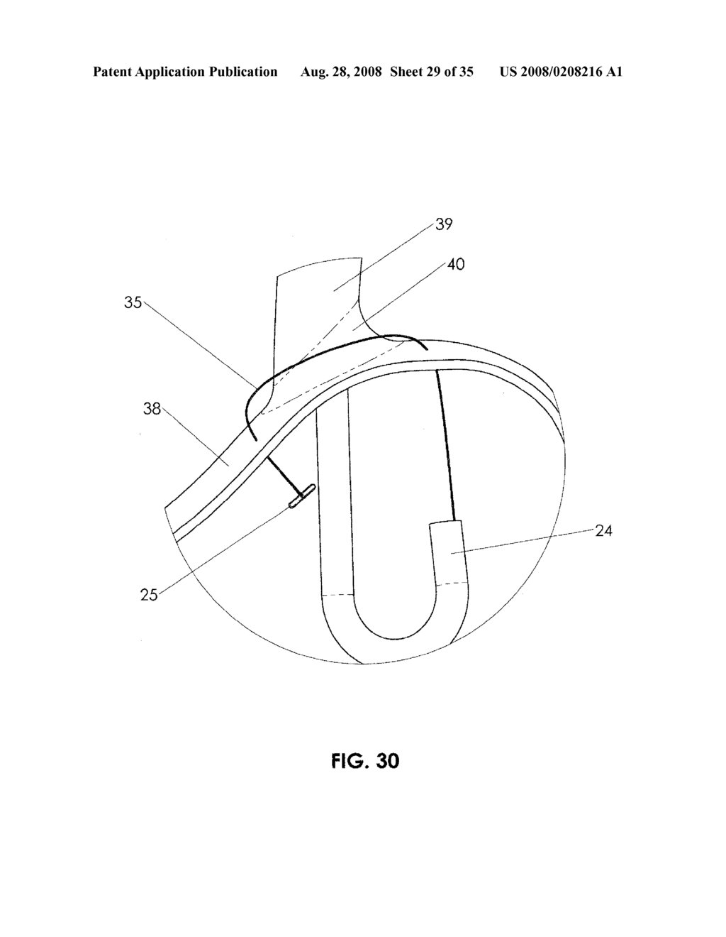 METHODS AND DEVICES FOR ENDOSCOPIC TREATMENT OF ORGANS - diagram, schematic, and image 30