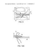 SUTURE PASSING INSTRUMENT AND METHOD OF PASSING SUTURE diagram and image