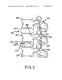 PEDICLE BASED SPINAL STABILIZATION WITH ADJACENT VERTEBRAL BODY SUPPORT diagram and image