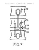 PEDICLE BASED SPINAL STABILIZATION WITH ADJACENT VERTEBRAL BODY SUPPORT diagram and image