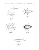 Method for treating myocardial infarction diagram and image