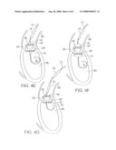 METHOD AND APPARATUS FOR REPLACING A PROSTHETIC VALVE diagram and image