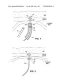 System and method for anchoring stomach implant diagram and image