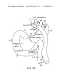 Use of a gastrointestinal sleeve to treat bariatric surgery fistulas and leaks diagram and image