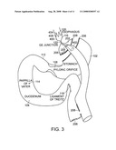 Use of a gastrointestinal sleeve to treat bariatric surgery fistulas and leaks diagram and image