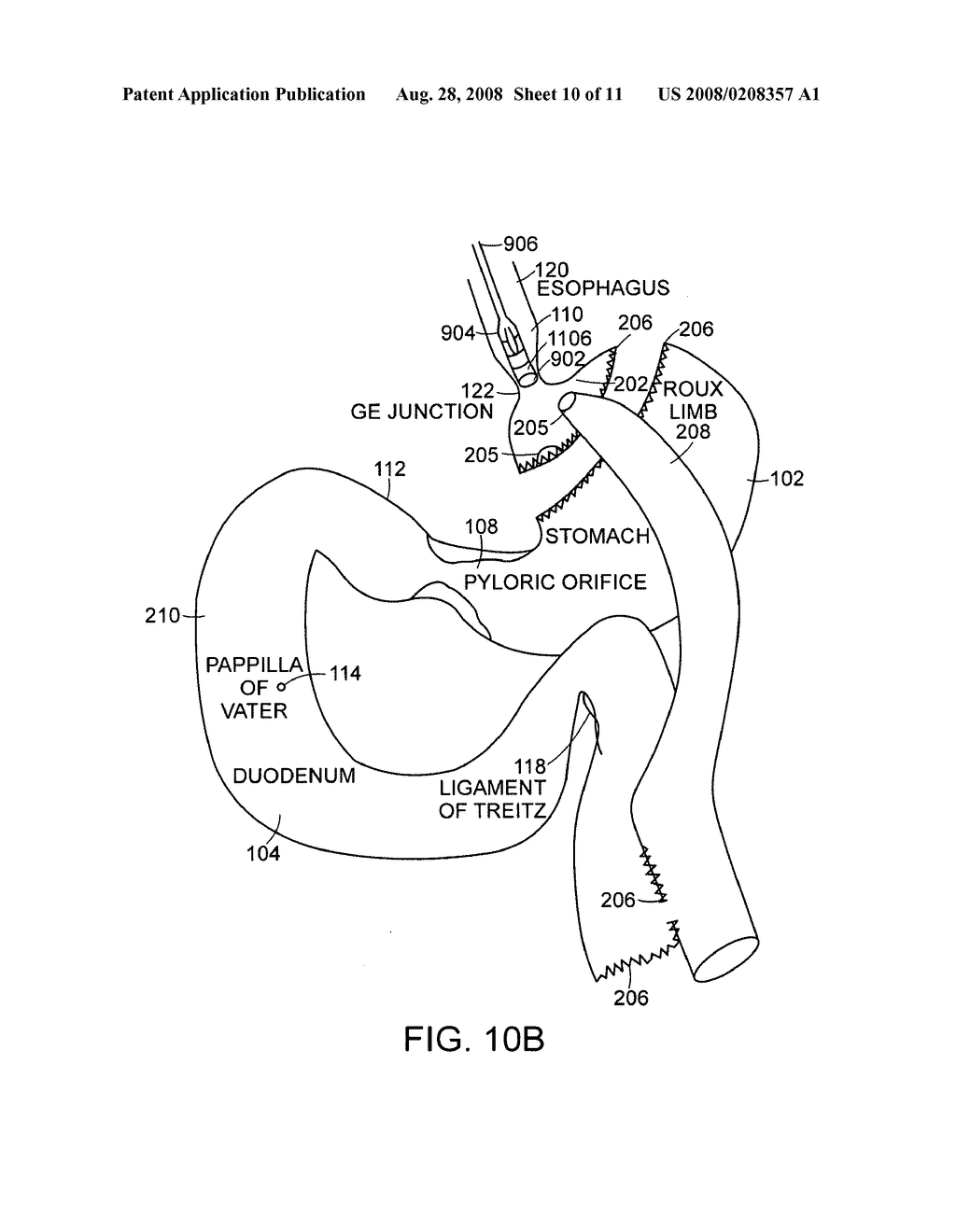 Use of a gastrointestinal sleeve to treat bariatric surgery fistulas and leaks - diagram, schematic, and image 11