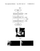 Fibrin Contained Semi-Solid Osteoblast Composition for Curing Bone Fracture and Method for Producing the Same diagram and image
