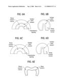 Graded glass/ceramic/glass structures for damage resistant ceramic dental and orthopedic prostheses diagram and image