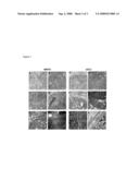  Method for Distinguishing Follicular Thyroid Adenoma (FTA) from Follicular Thyroid Carcinoma (FTC) diagram and image