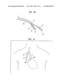 SPLITABLE TIP CATHETER WITH BIORESORBABLE ADHESIVE diagram and image