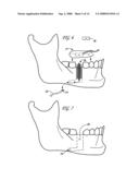 APPARATUS AND METHOD FOR USING AN INTRAOSSEOUS SPACE FOR MOVING FLUID INTO AND OUT OF THE BODY diagram and image