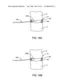 SPINAL DIAGNOSTIC METHODS AND APPARATUS diagram and image