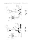 Method and Apparatus for Inhibiting Pain Signals During Vacuum-Assisted Medical Treatments of the Skin diagram and image