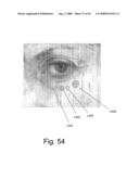 Method and Apparatus for Inhibiting Pain Signals During Vacuum-Assisted Medical Treatments of the Skin diagram and image