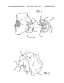 MARKING TEMPLATE FOR INSTALLING A CUSTOM REPLACEMENT DEVICE FOR RESURFACING A FEMUR AND ASSOCIATED INSTALLATION METHOD diagram and image