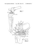 MARKING TEMPLATE FOR INSTALLING A CUSTOM REPLACEMENT DEVICE FOR RESURFACING A FEMUR AND ASSOCIATED INSTALLATION METHOD diagram and image