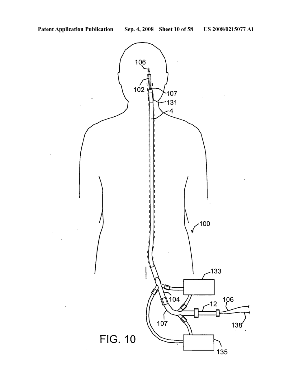 Systems, methods and devices for removing obstructions from a blood vessel - diagram, schematic, and image 11