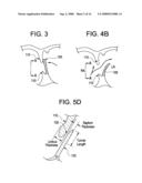 SINGLE DISC INTRALUMINAL FIXATION PATENT FORAMEN OVALE CLOSURE DEVICE diagram and image