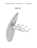 SINGLE DISC INTRALUMINAL FIXATION PATENT FORAMEN OVALE CLOSURE DEVICE diagram and image