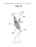 SINGLE DISC INTRALUMINAL FIXATION PATENT FORAMEN OVALE CLOSURE DEVICE diagram and image