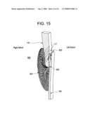 SINGLE DISC INTRALUMINAL FIXATION PATENT FORAMEN OVALE CLOSURE DEVICE diagram and image