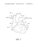 Apparatus and method for temporary treatment of acute heart failure decompensation diagram and image