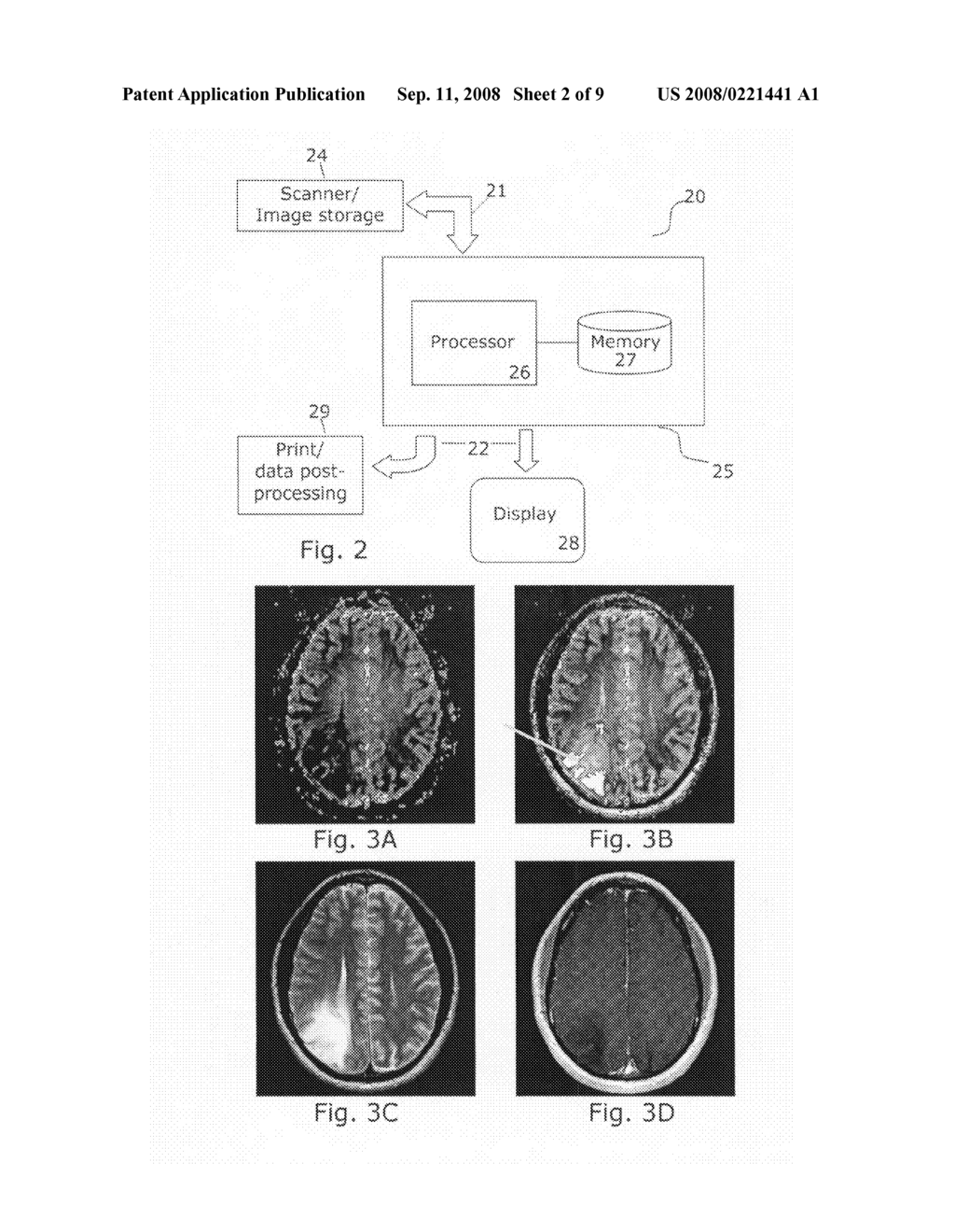 Tumor grading from blood volume maps - diagram, schematic, and image 03