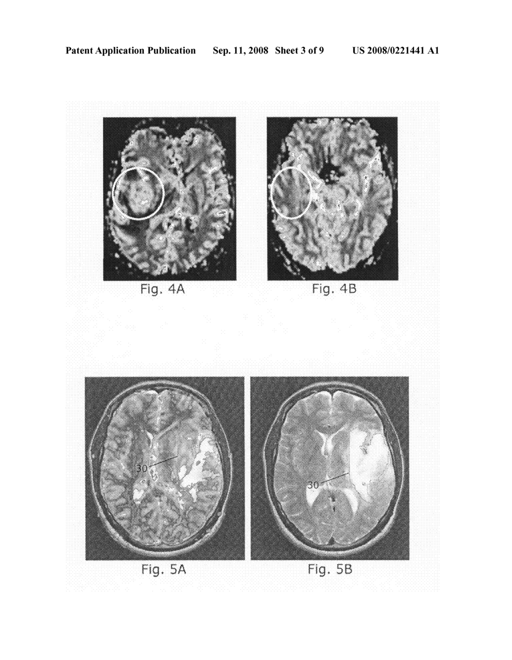 Tumor grading from blood volume maps - diagram, schematic, and image 04