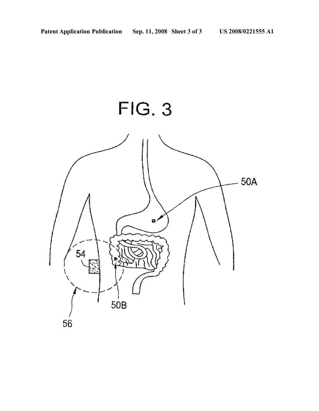 METHOD FOR WIRELESSLY MONITORING IMPLANTED MEDICAL DEVICE - diagram, schematic, and image 04