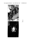 Method and apparatus for detecting and achieving closure of patent foramen ovale diagram and image