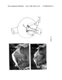 Method and apparatus for detecting and achieving closure of patent foramen ovale diagram and image