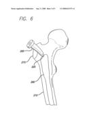 EXPANDABLE BLADE DEVICE FOR STABILIZING LONG BONE FRACTURES diagram and image