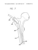 EXPANDABLE BLADE DEVICE FOR STABILIZING LONG BONE FRACTURES diagram and image