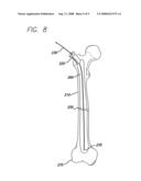 EXPANDABLE BLADE DEVICE FOR STABILIZING LONG BONE FRACTURES diagram and image